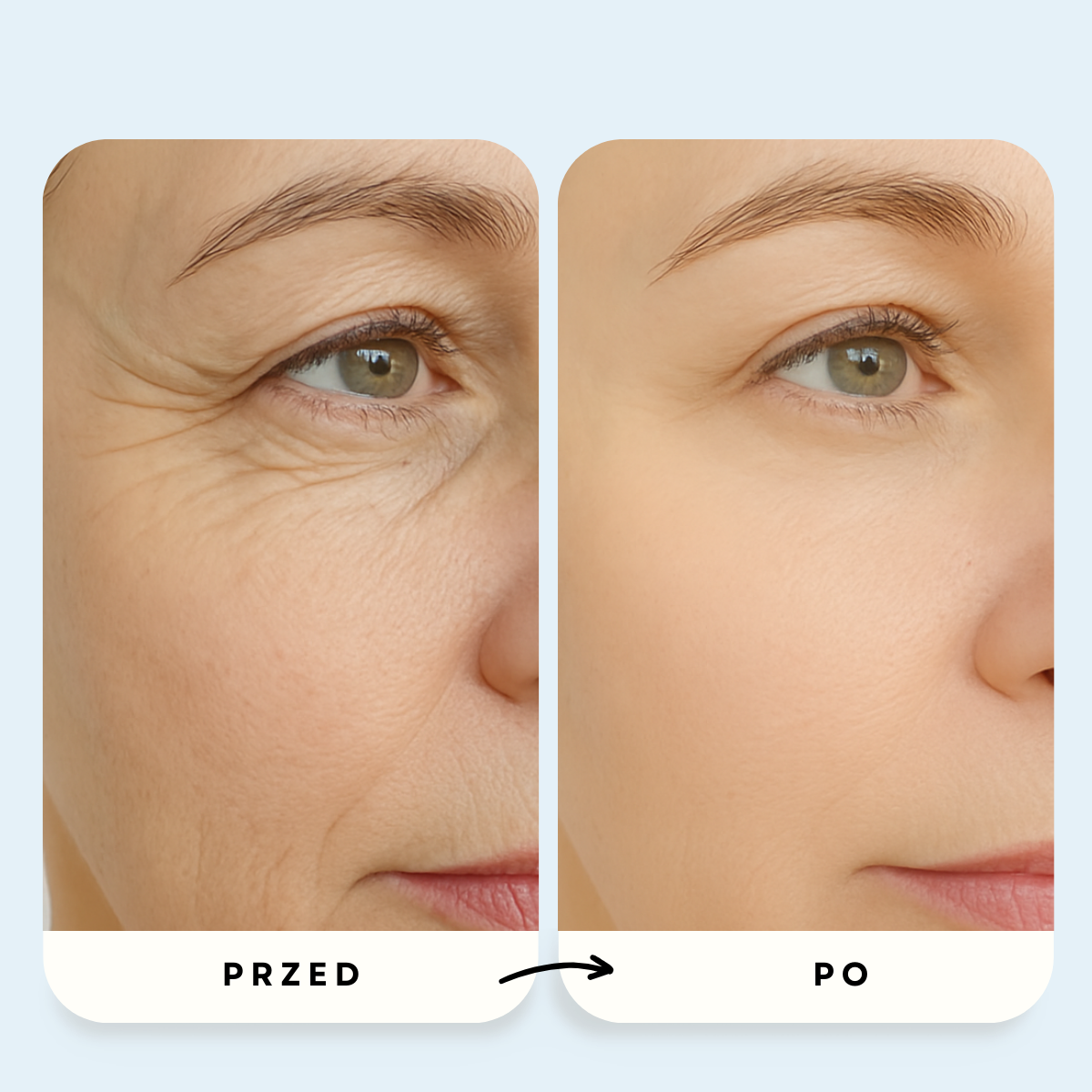 System Mikroinfuzji PDRN