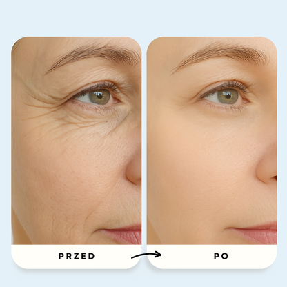 System Mikroinfuzji PDRN