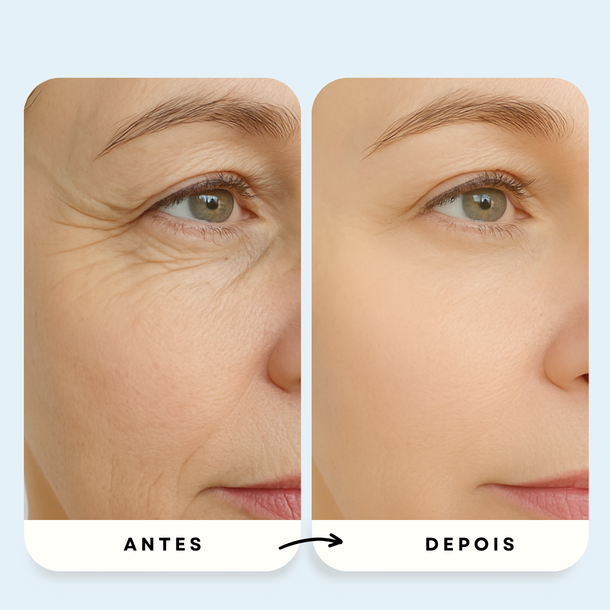 Sistema de Microinfusão PDRN