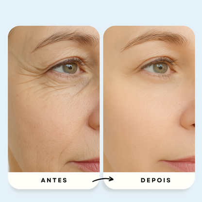 Sistema de Microinfusão PDRN