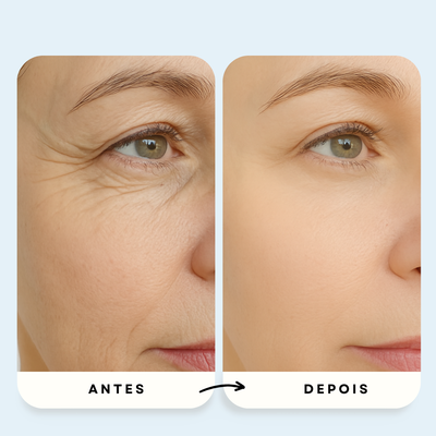 Sistema de Microinfusão PDRN