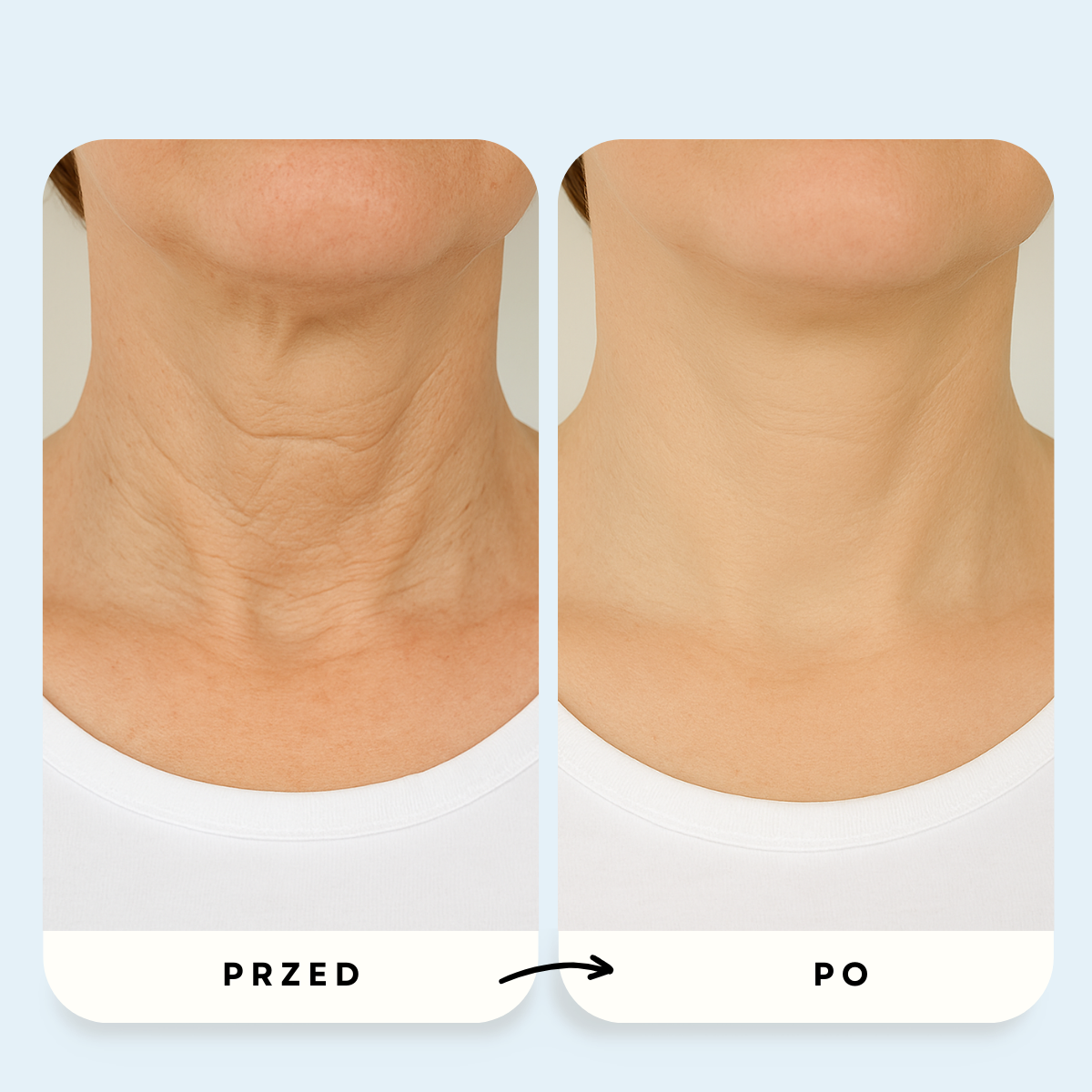 System Mikroinfuzji PDRN