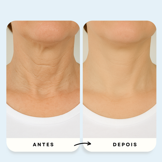 Sistema de Microinfusão PDRN