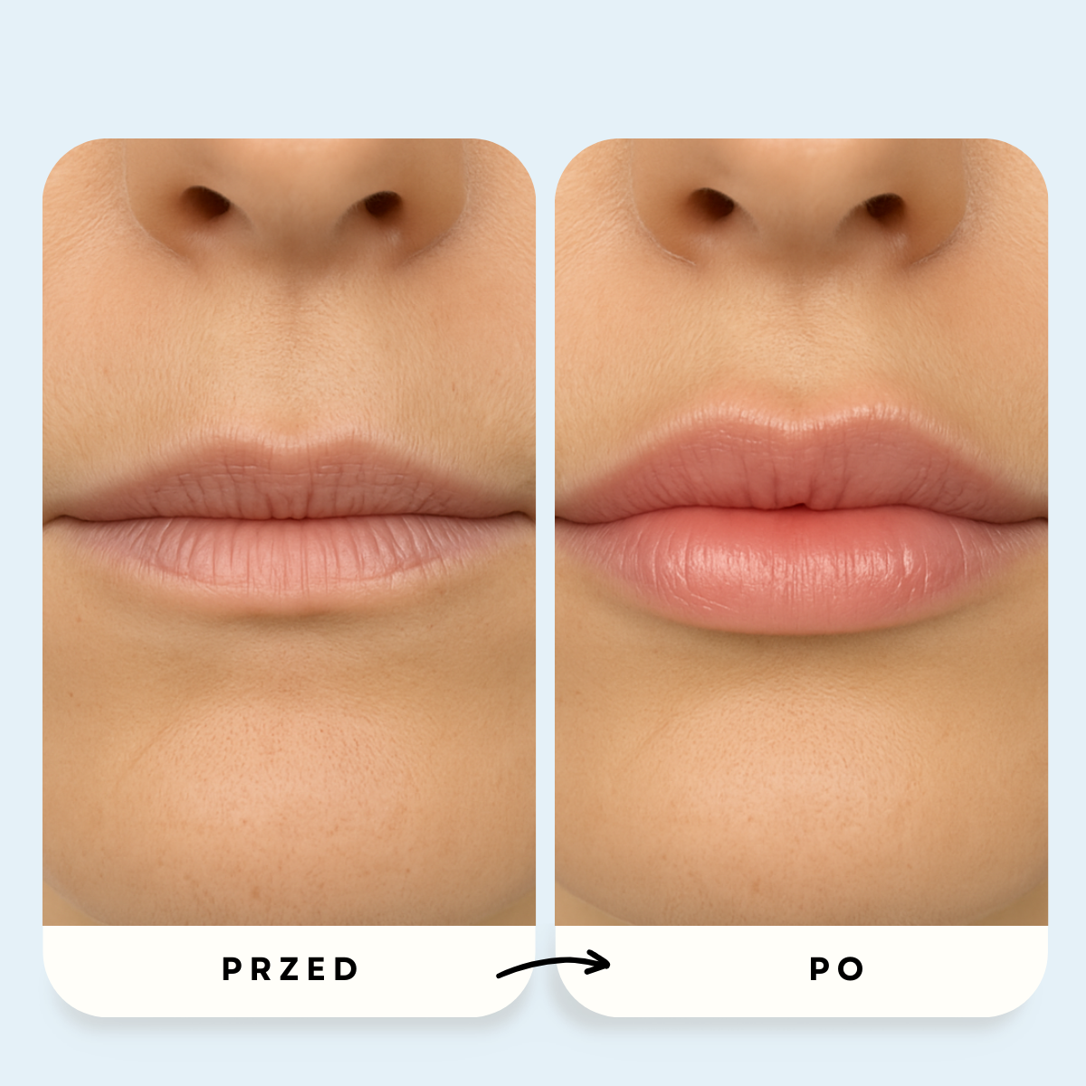 System Mikroinfuzji PDRN