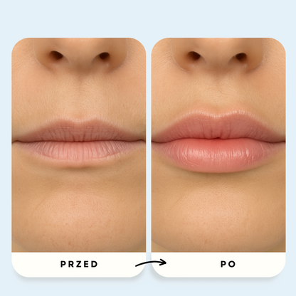 System Mikroinfuzji PDRN