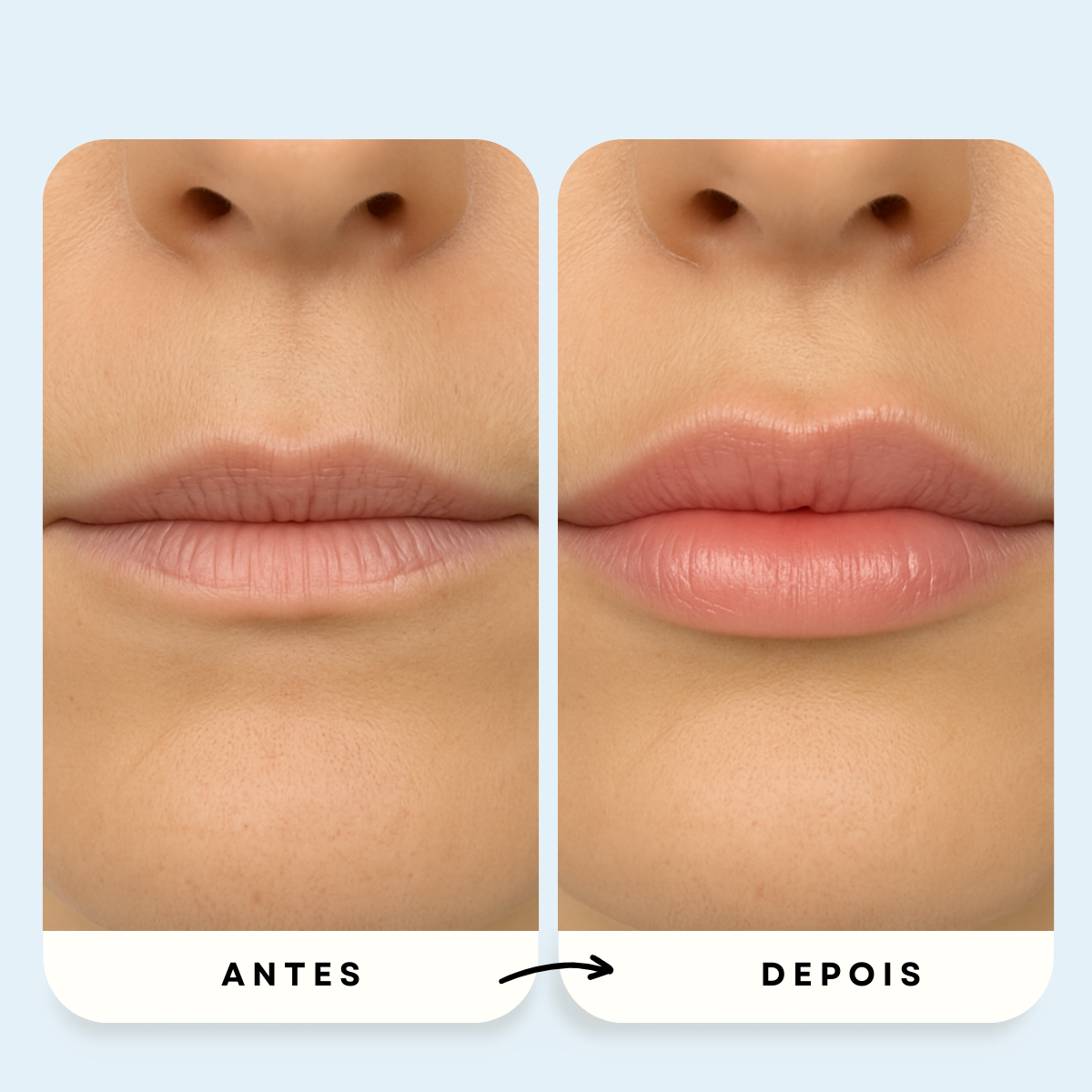 Sistema de Microinfusão PDRN