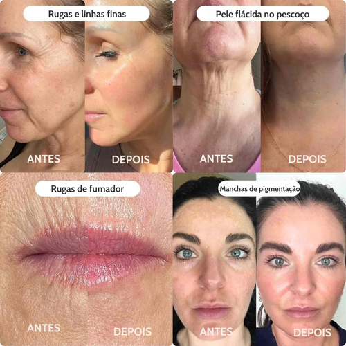 Sistema de Microinfusão PDRN